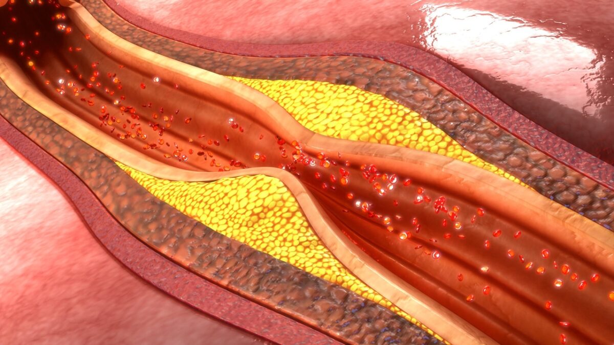 3D-Darstellung einer verengten Arterie durch arterielle Plaques.
